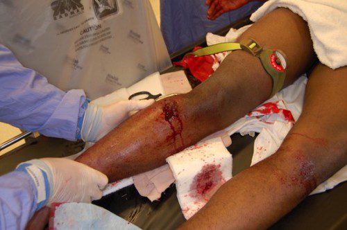 impacto de bala pierna